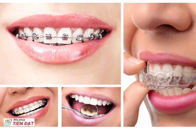 Quy trình niềng răng và các loại mắc cài niềng răng hiện nay