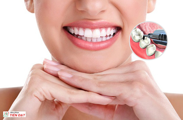Mất răng sau có nên trồng răng không?