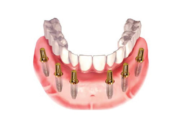 Trồng răng implant nguyên hàm phục hồi chức năng ăn nhai