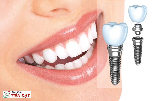Cấy ghép implant giải pháp hiệu quả cho răng miệng